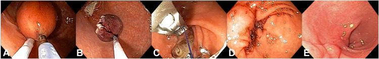 VideoGIE Journal (@videogie) on Twitter photo VideoGIE Editor's Choice: “Endoscopic resection of a gastric GI stromal tumor using the helix-snaring technique” by Luiz Gustavo de Quadros et al. videogie.org/article/S2468-…
<a href="/VBrunaldi/">Vitor Brunaldi MD MSc PhD</a> VideoGIE Editor's Choice: “Endoscopic resection of a gastric GI stromal tumor using the helix-snaring technique” by Luiz Gustavo de Quadros et al. videogie.org/article/S2468-…
<a href="/VBrunaldi/">Vitor Brunaldi MD MSc PhD</a>