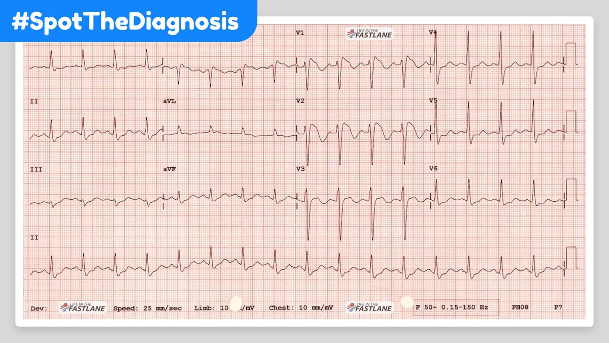 EM3FOAMed's tweet photo. [QUIZ] 32-year-old male of South East Asian heritage presents with an unexplained syncopal episode 😵‍💫 He is normally fit and well but felt slightly unwell with a fever yesterday. Now he's feeling fine and wants to know if he can be discharged? 

Continue this thread to answer 👇