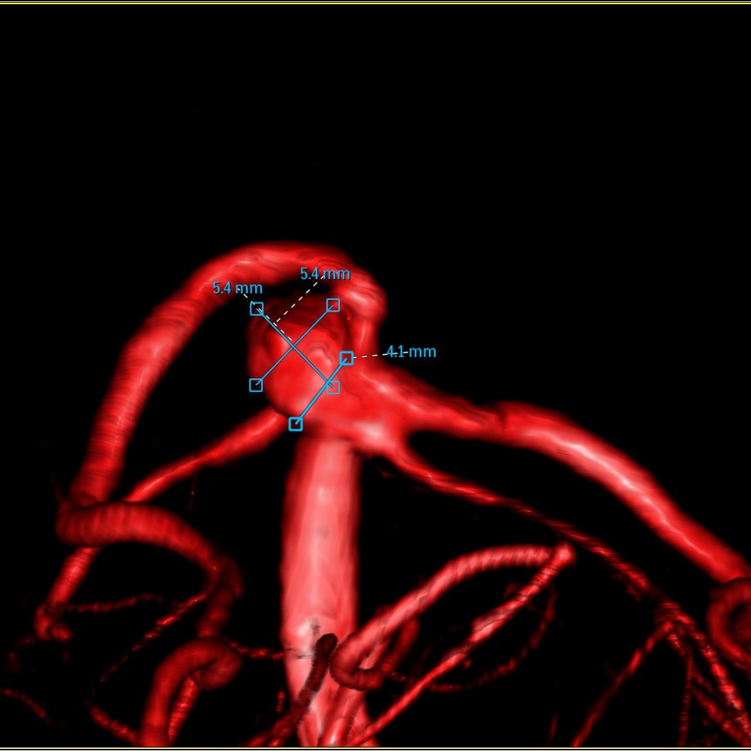 VirTauli's tweet photo. Mujer 73 a con pérdida de conciencia de 30’’ y diplopia binocular horizontal/vertical.

DSA de ACI y AV bilat + 3D desde AV der.
Hallazgo de aneurisma sacular de cuello ancho en Top de AB con disposición anterior lateral izq (5.4x5.4mm, cuello 4.1mm) origen en ostium ACS/ACP izq. https://t.co/ffB5HslX7D