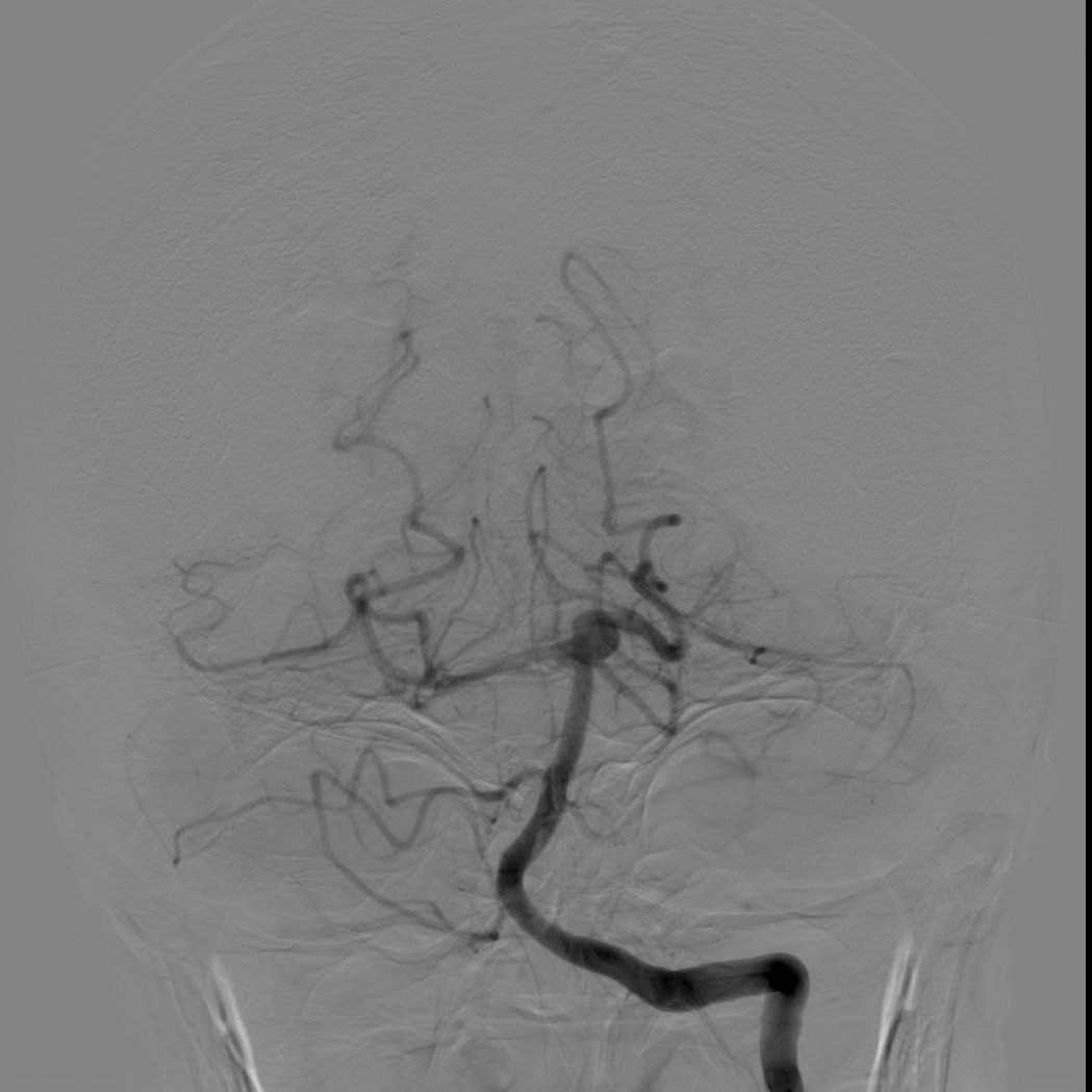 VirTauli's tweet photo. Mujer 73 a con pérdida de conciencia de 30’’ y diplopia binocular horizontal/vertical.

DSA de ACI y AV bilat + 3D desde AV der.
Hallazgo de aneurisma sacular de cuello ancho en Top de AB con disposición anterior lateral izq (5.4x5.4mm, cuello 4.1mm) origen en ostium ACS/ACP izq. https://t.co/ffB5HslX7D