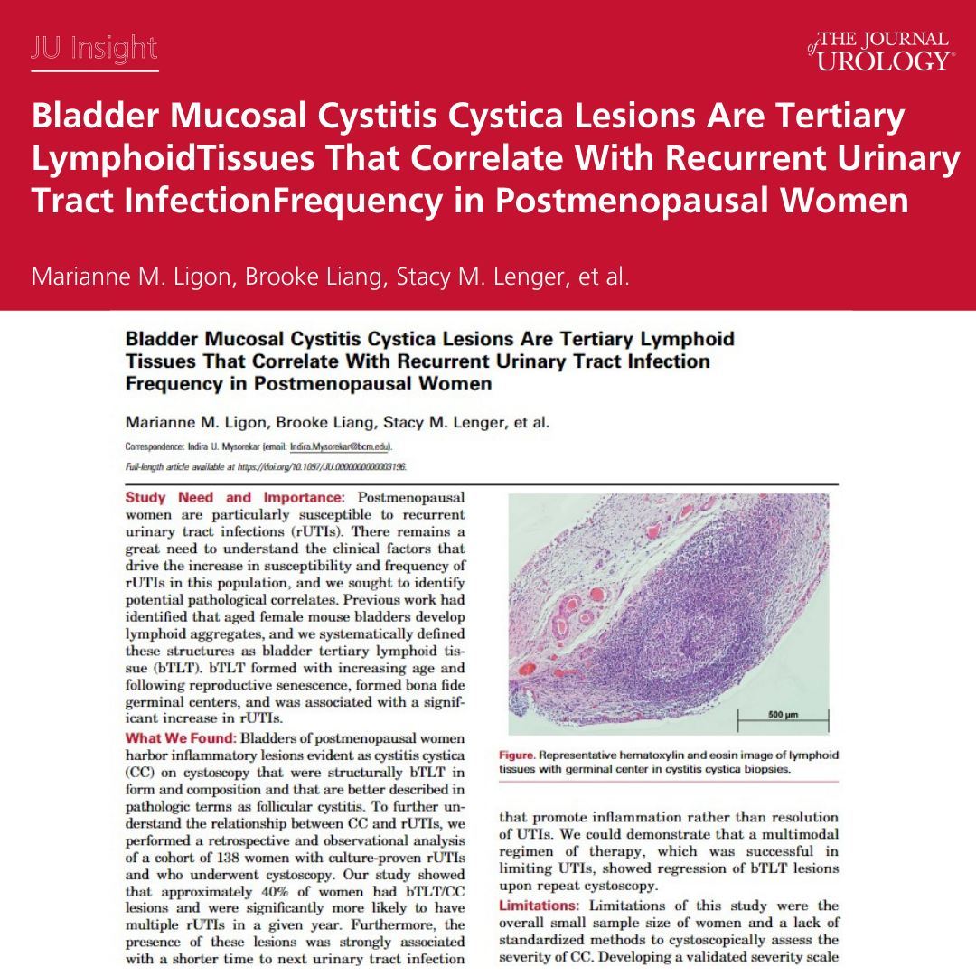 Bladder Mucosal Cystitis Cystica Lesions Are Tertiary Lymphoid Tissues That Correlate With Recurrent Urinary Tract Infection Frequency in Postmenopausal Women  auajournals.org/doi/10.1097/JU…