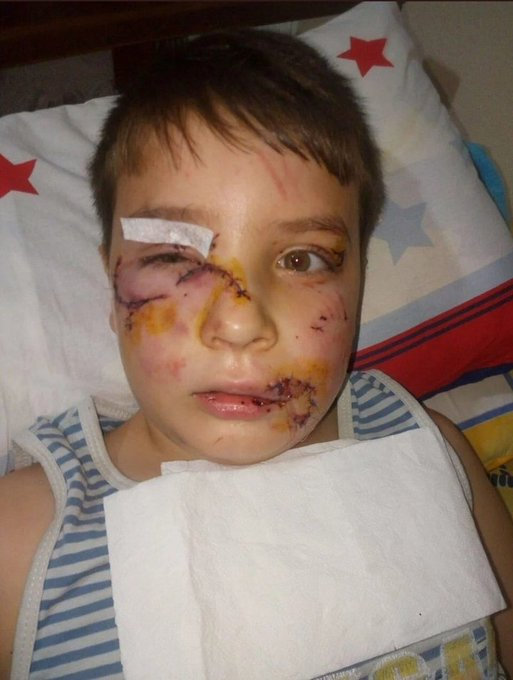 Şu güzel çocuğu
bu hale getiren
başıboş sokak köpekleri dahil

Türkiye'de bulunan tüm sahipsiz köpekler UYUTULMALIDIR!!!!!

<a href="/RTErdogan/">Recep Tayyip Erdoğan</a>
<a href="/TBMMresmi/">TBMM</a>
<a href="/TC_icisleri/">T.C. İçişleri Bakanlığı</a>
<a href="/Suleymansoylu/">Süleyman Soylu</a>
<a href="/csbgovtr/">T.C. Çevre, Şehircilik ve İklim Dğş. Bakanlığı</a>
#KöpekTerörü #KöpekSorunu #KöpekleriUyutun
@YdkBasibosTehli