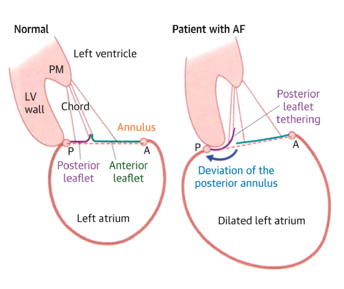 🫀 Arrythmia-Mediated Valvular Heart Disease #CardioEd #Cardiology #CardioTwitter