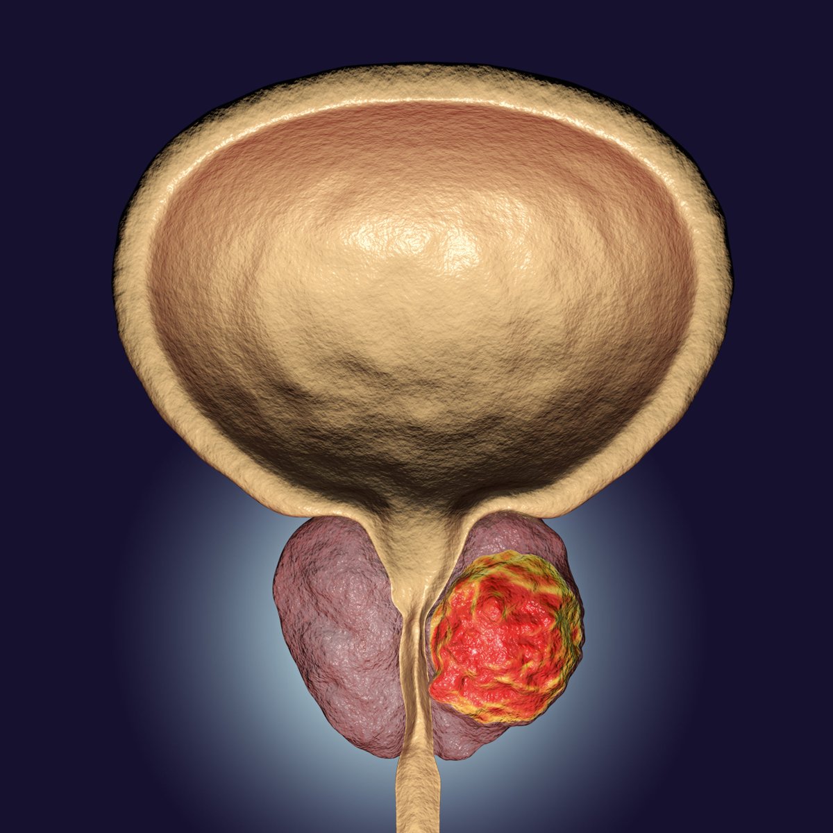 Patients undergoing primary prostatectomy have the option of undergoing salvage #radiationtherapy; however, the optimal management modality of postprimary radiation therapy #prostatecancer recurrence is unclear. buff.ly/3qeDPff