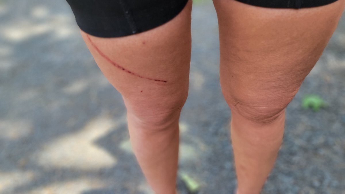 I feel tough with my mountain bike wound. 
#trailriding #bikes #mountainbiking