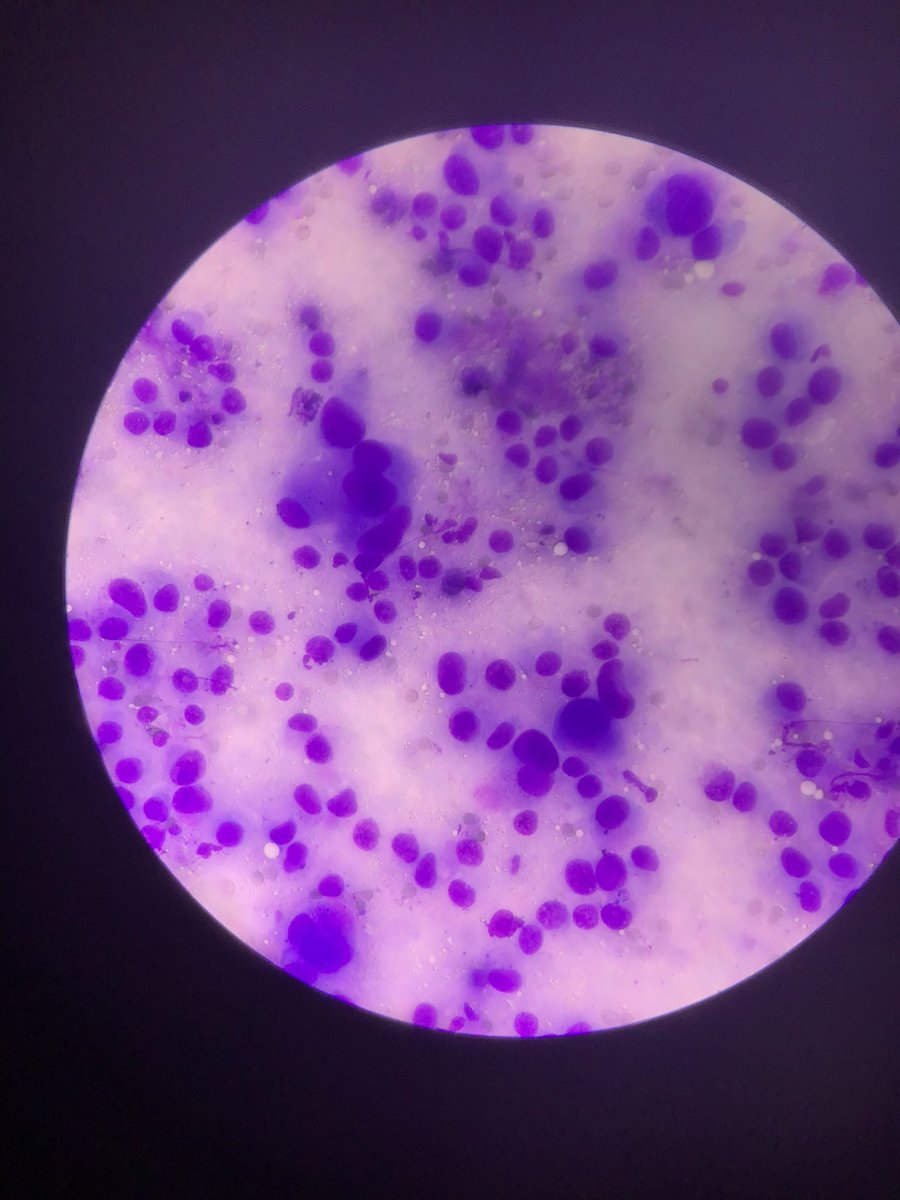DrPrernaPath's tweet photo. A FNAC from patotid gland , slow growing, causing bells palsy from a 52 yr male 
#cytopath #fnac #cytology #parotid

I https://t.co/N6HISwFWlm