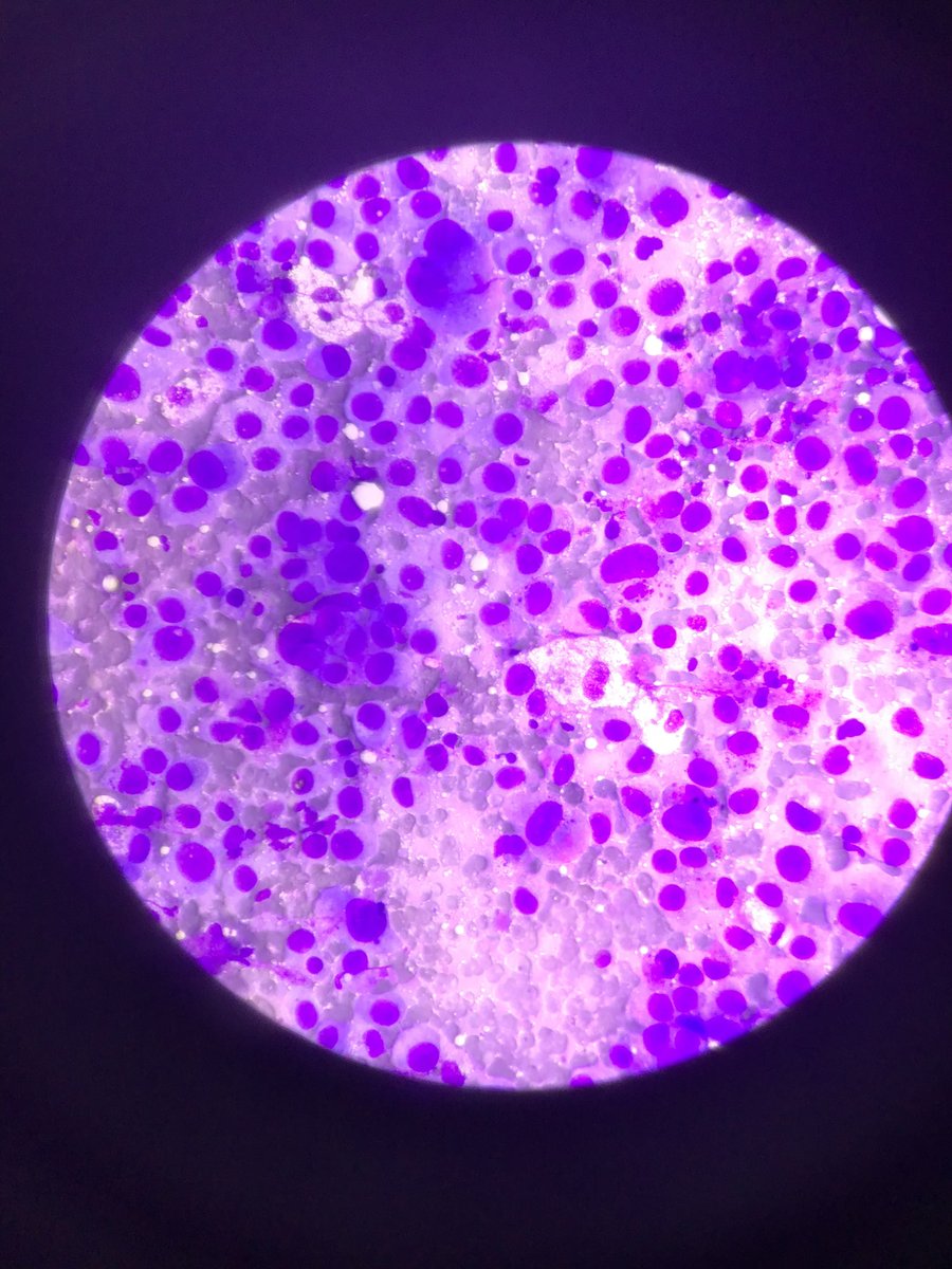 DrPrernaPath's tweet photo. A FNAC from patotid gland , slow growing, causing bells palsy from a 52 yr male 
#cytopath #fnac #cytology #parotid

I https://t.co/N6HISwFWlm