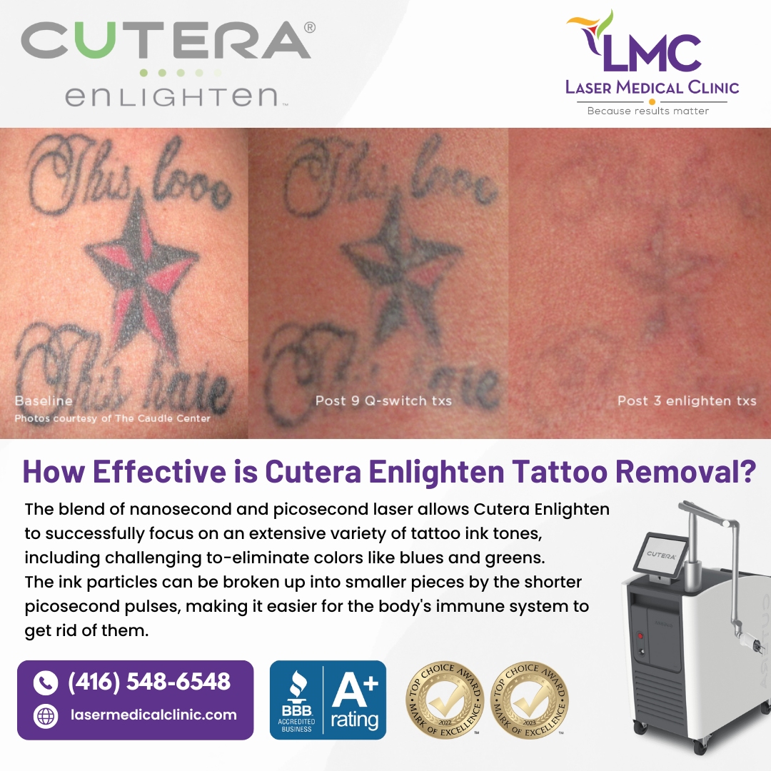 lmclaser's tweet image. #LaserTattooRemoval has come a long way. Recent #CuttingEdgeTechnology is making it #HighlyEfficient and able to #BreakDownInkParticles with ease.

🌎Read More: lasermedicalclinic.com/how-effective-…

#CuteraEnlightenTattooRemovalEffectiveness #CuteraEnlightenTattooRemoval #TattooRemovalService
