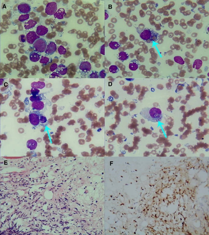 Benlazar S M A on Twitter: "Phagocytic rhabdomyosarcoma cells in bone