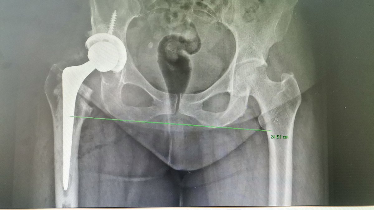 DrDDA2's tweet photo. Case wrap up. 55 y fem, 1.48 mts
Dysplastic
Posterolateral approach
Trident PSL 50. Decides to elevate de CoR for better coverage and get  36 head. 1 screw "just for the picture". Femoral anteversion 35-40 degrees intraop. Cemented Exeter 35.5 offset, 32+4 ceramic head. https://t.co/VQq2fulkJt