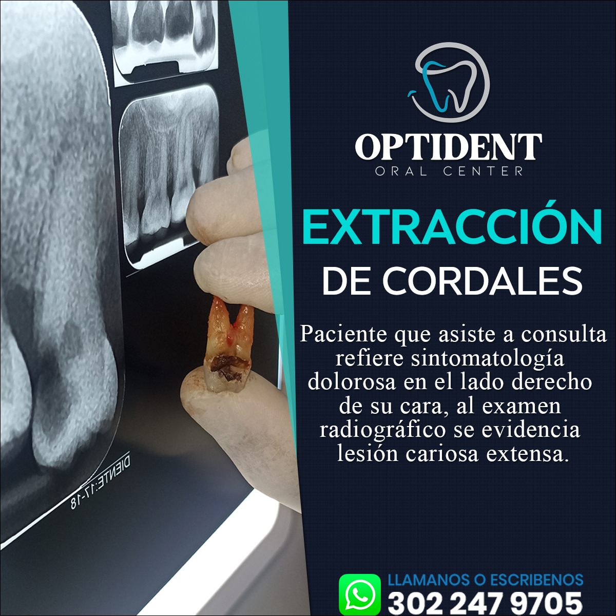 OptidentOralCen's tweet photo. Implica sacar los molares que se encuentran en la parte posterior de la boca, que están causando dolor u otros problemas.
📱📲 Agenda tu cita: 3022479705
#ortodoncia #optidentoralcenter #Brackets #Odontología #yumbo #extracción #extraccionesdentales #cordales #cordal #muelas https://t.co/ESCGVNcKbj