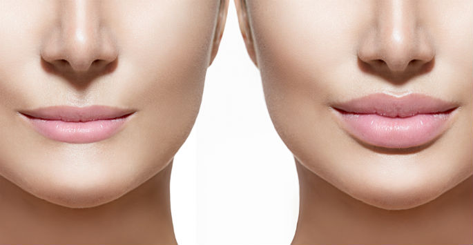 Want full, sensual lips? We can help with #LipEnhancement! biotechwellnesscenter.com/facial-rejuven…