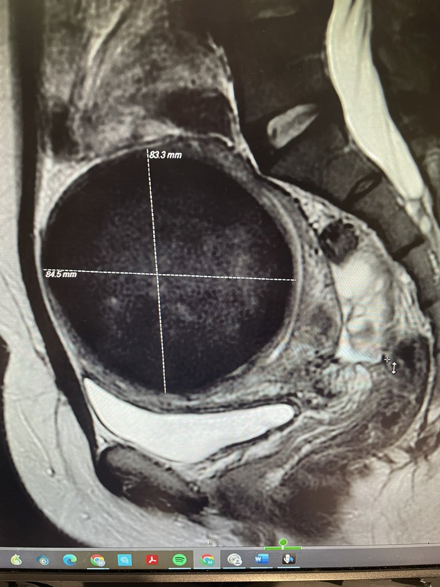 Why MRI pre-UAE?
31 yo desp wants Baby 2. After Baby 1 she had a miscarriage with huge hemorrhage. Send for possible UAE.

Turns out, her pregnancy caused fibroid infarction (known to do that…)

UAE would not have helped her. Ultrasound would not determine lack of enhancement.