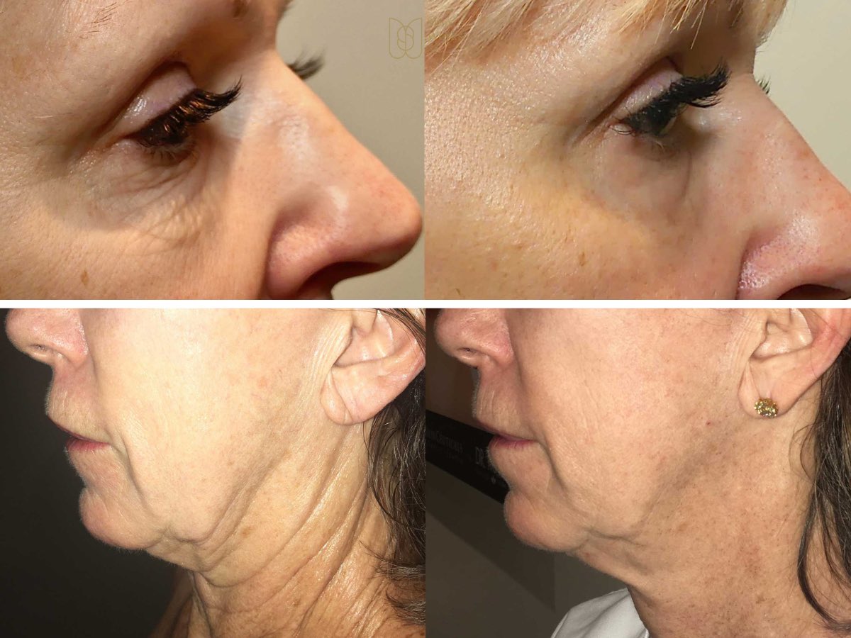 Our clients have consistently been thrilled with their Morpheus8 results. Check out these before and after photos to see for yourself! #RealResults 7/8