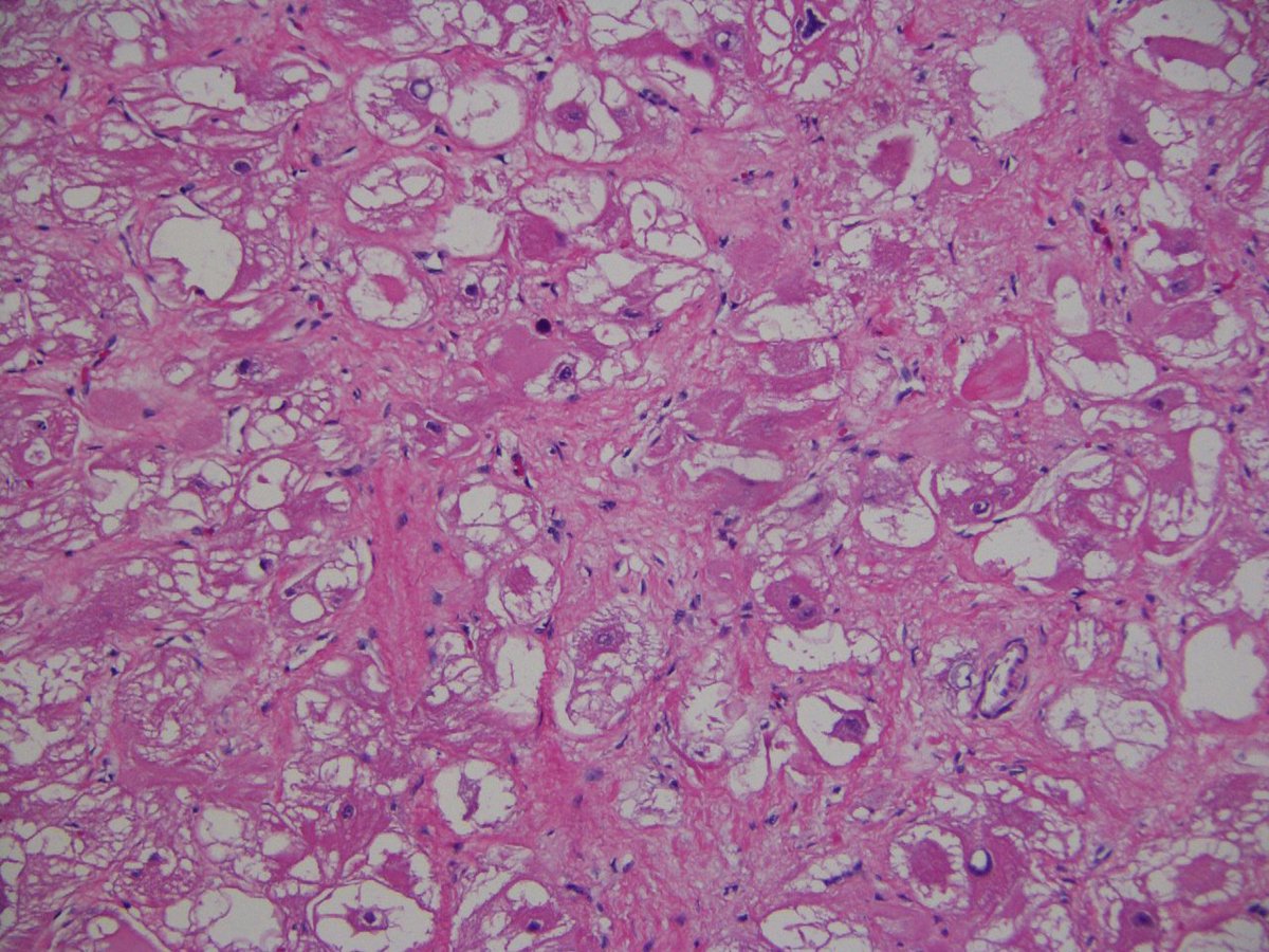 Heart mass in a patient with tuberous sclerosis- a classic example of cardiac rhabdomyoma #pedipath #pathtwitter #CVpath #cardiacpath