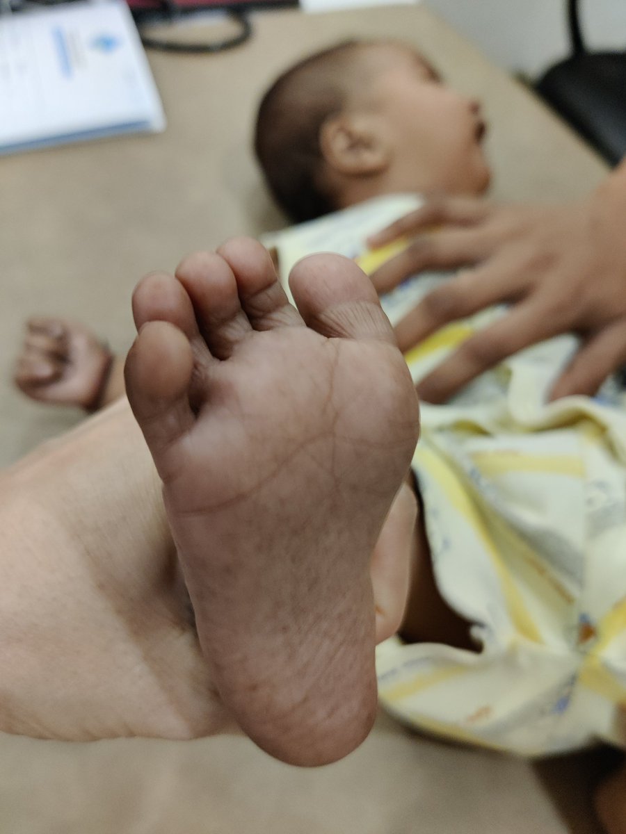 Snehal_Spandan's tweet photo. A 6 month old presented with generalised hypotonia, regression of milestones, noisy breathing and pigmentation of hands and legs. Please note the disappearance of pigmentation post treatment. Can you guess diagnosis? #Pediatrics #ssspost #learning https://t.co/t8lROlx78Z