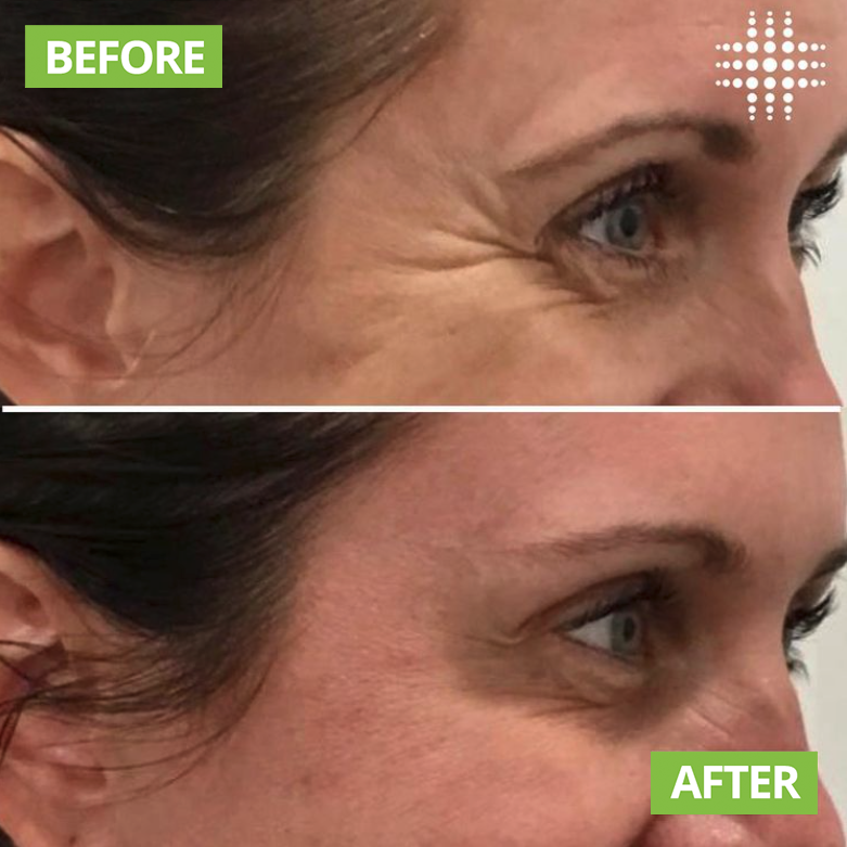 ResultsLaser's tweet image. The softening of crows feet with Anti-Wrinkle Injections. Photos taken 2 weeks apart.

Save time, book online - link in bio

#resultslaserclinic #finelines #wrinkles #ageingskin #antiwrinkle #foreheadlines #frownlines #lipflip #bunnylines #necklines #crowsfeet #expressionlines