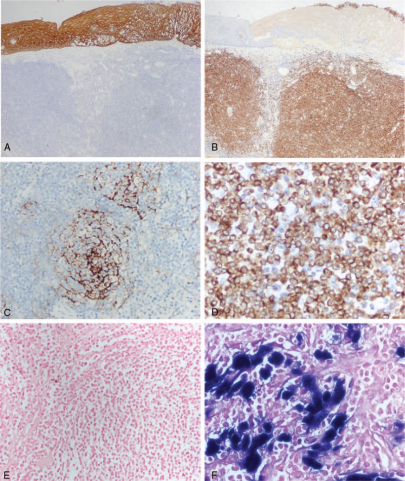 pathobotology's tweet photo. #Pathology #quiz!
1. What tissue is this (#gipath)?
2. What is in your differential?
3. What is your diagnosis? #WiyD
Case details will be posted as a reply soon! https://t.co/NB2MWWMjWg