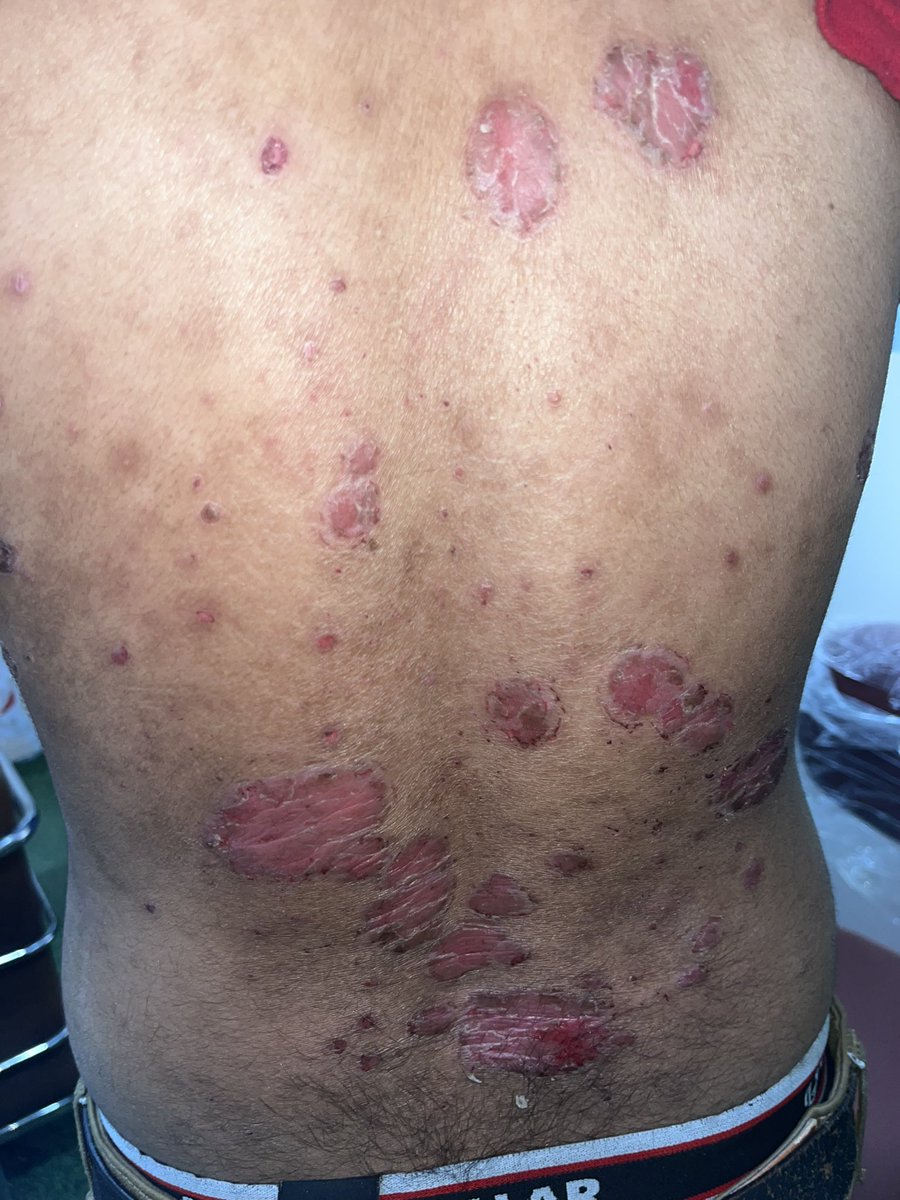 The Skin Doctor🩺MD Skin&VD)Consultant Dermatology tweet media