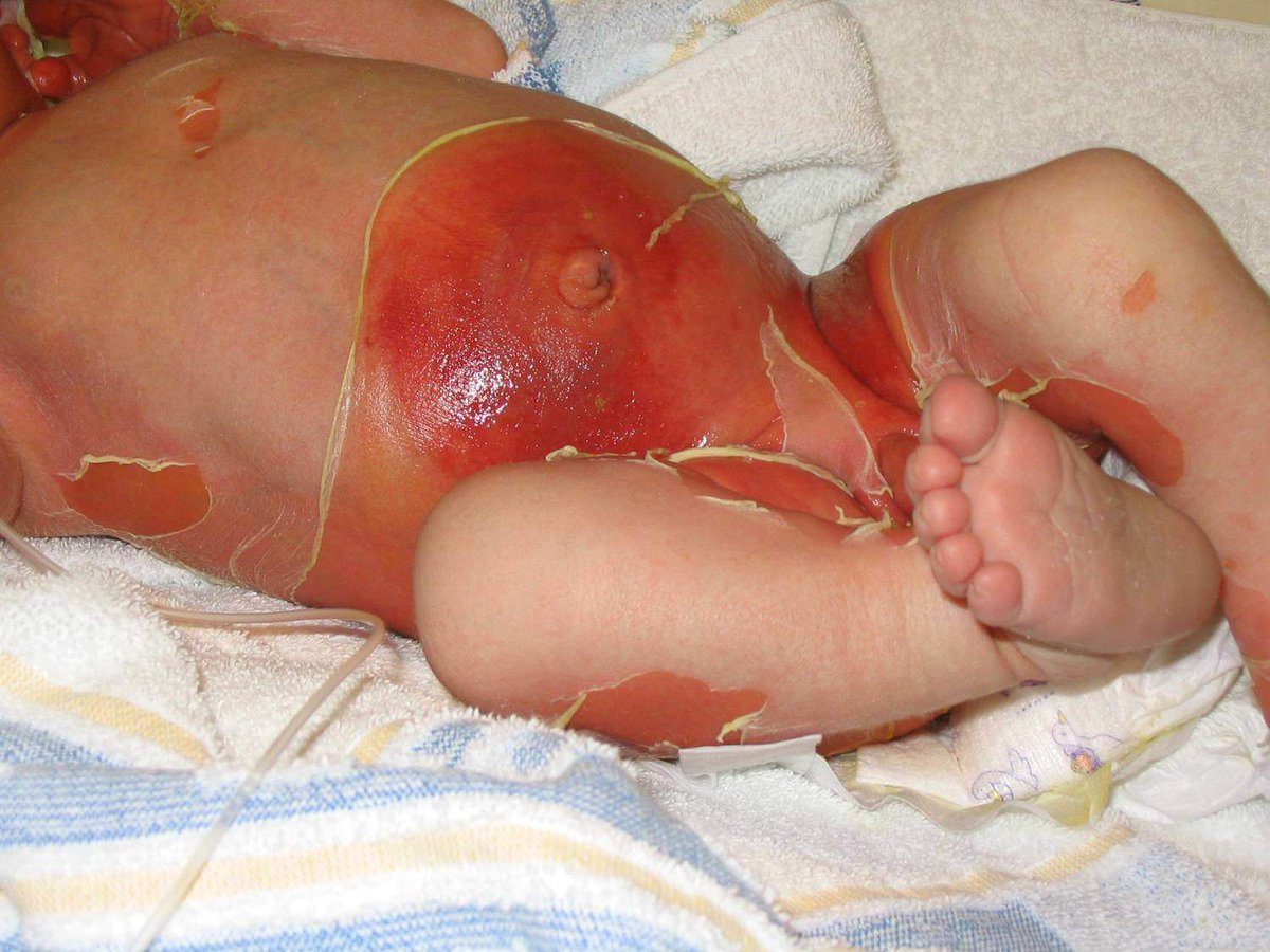 Not hot water splash♨️
Spot the diagnosis. What is the causative agent for this condition?
#MedTwitter #Pediatrics #newborn #infection #medicalstudents #MedEd #ClinicalPearl #spotdiagnosis