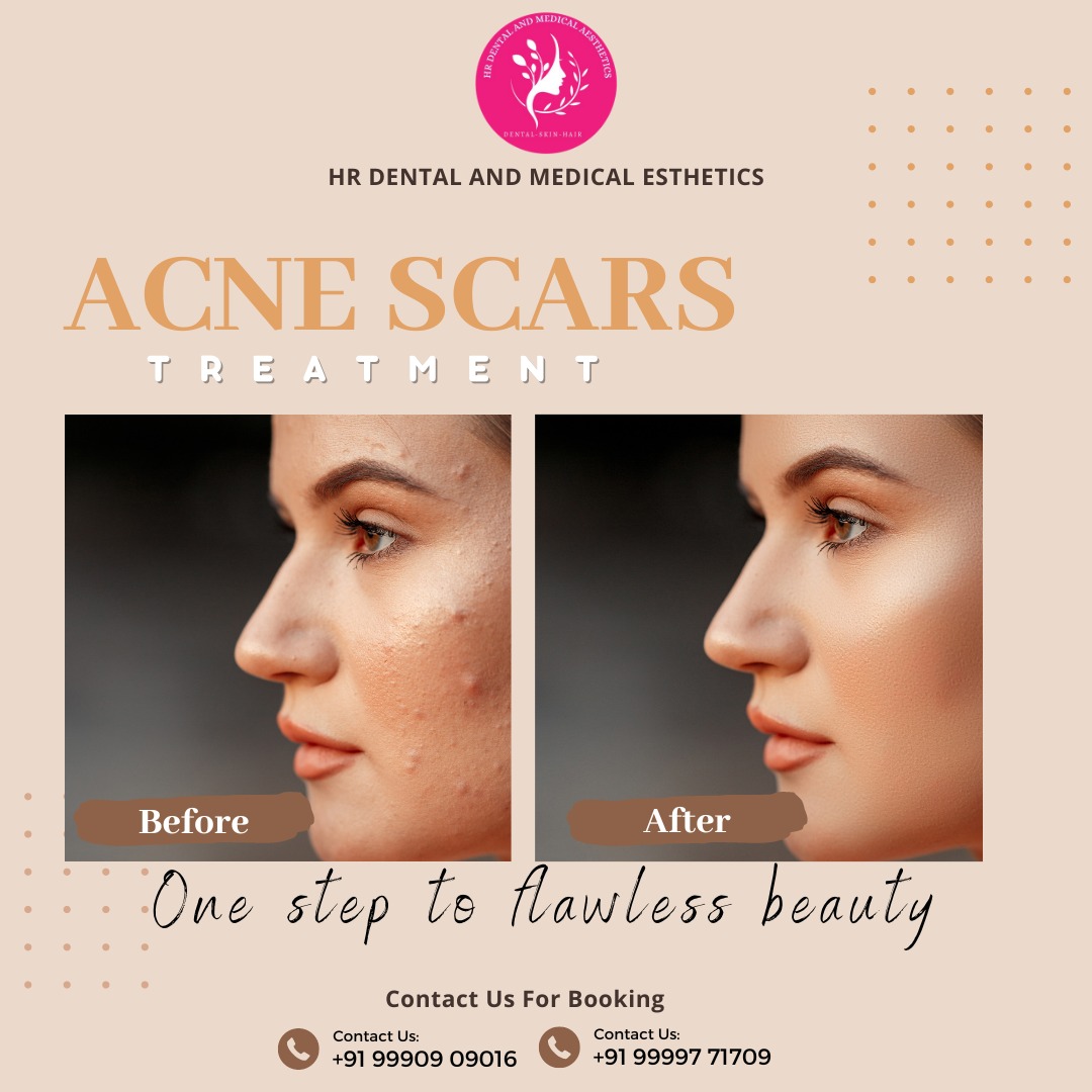 Say goodbye to acne scars with the amazing treatment at HR Dental And Medical Aesthetics! 

For bookings, call Dr. Himani Bhardwaj at +91 99997 71709 or visit our clinic at SB 34, Shashtri Nagar, Ghaziabad.

#AcneScarsTreatment #AcneSolutions #SkinCareClinic #Dermatology