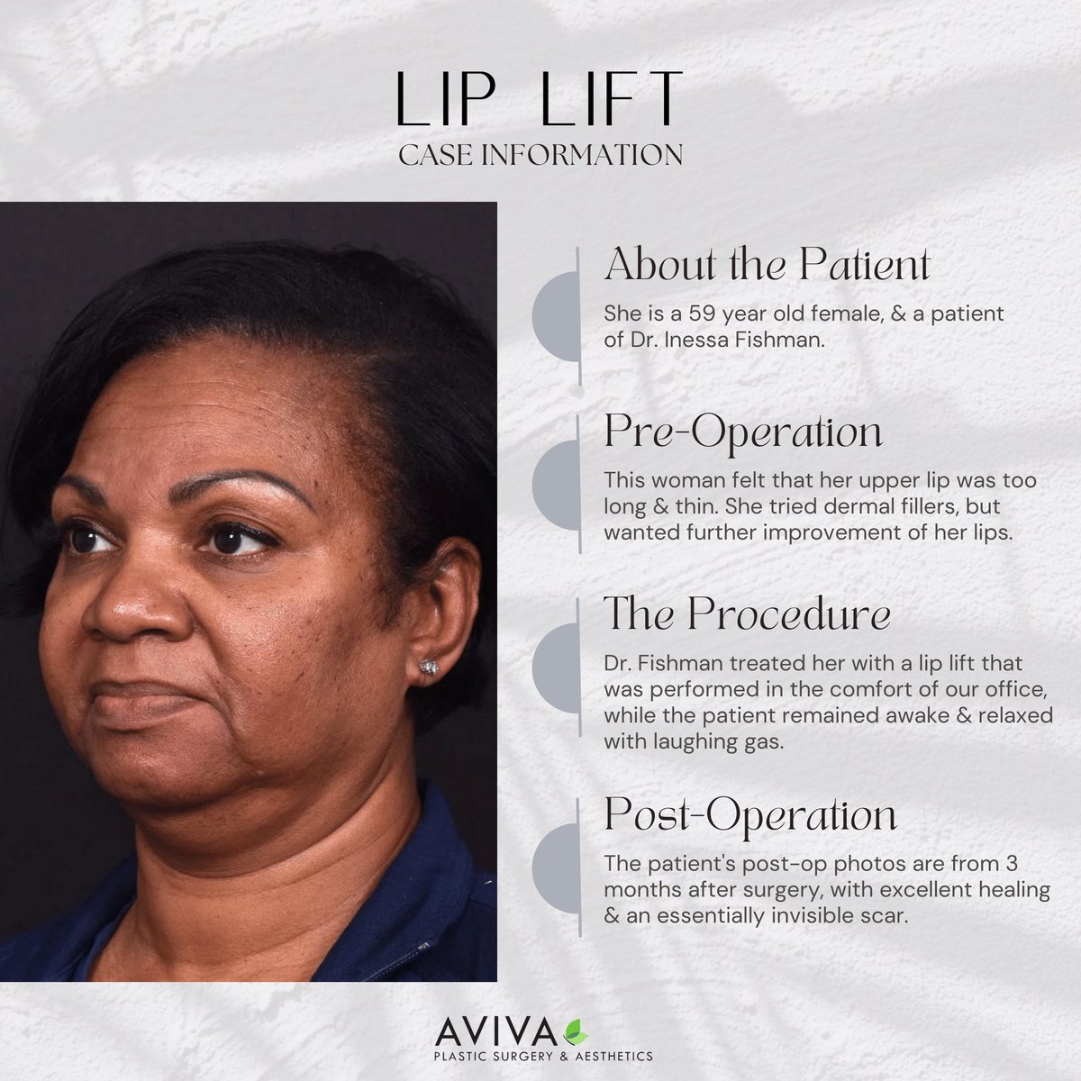 𝐋𝐢𝐟𝐭 𝐢𝐭 real good! 
✨  𝒫𝓇𝑜𝒸𝑒𝒹𝓊𝓇𝑒: Lip Lift 𝒟𝑜𝒸𝓉𝑜𝓇: Dr. Inessa Fishman⁣ A surgical #liplift is best for those with a too-long upper #lip that has been weighed down by time, excess filler, or genetics.  

#lipliftsurgery #beforeandafter