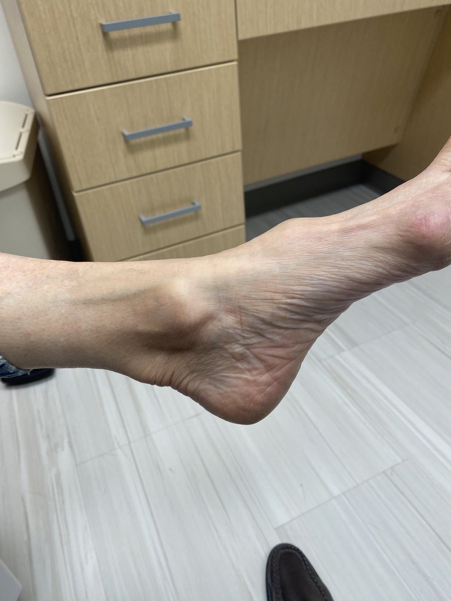 A first for me:Achilles tendon xanthoma and Charcot-Marie-Tooth syndrome features in the same foot. Looking forward to seeing my fellow lipid geeks at NLA