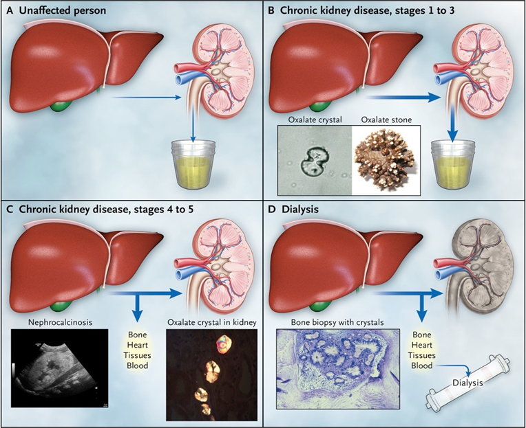 ckd_ce's tweet photo. 11) In this next phase:
*⃣ Plasma supersaturation with #CaOx ➡️systemic #oxalosis (retina, myocardium, vessel walls, skin, bone, and the central nervous system)
Synthesis and transfer of oxalate at various stages of PH1 are shown here 👇
https://t.co/hjVDbNLYBD https://t.co/swdmVOgbNi