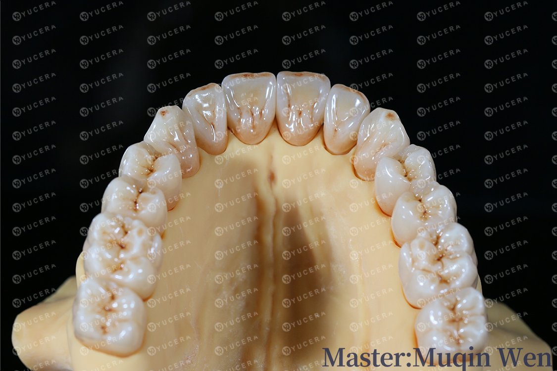 Yuceradental's tweet photo. 【Case Share】
Master: Wen Muqin
Materials:Yucera UT white zirconia blocks

#Yucera #dentist #esthetics #implant #whitening #smile #dental #lithiumdisilicate #emax #dentallab #dentalclinic #dentalmaterials #cadcam #wetcadcam #dentalmillingmachine #cadcammilling #dentallaboratory https://t.co/XZR5crzZzy