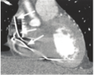 What artifact is indicated by the arrows in the image?