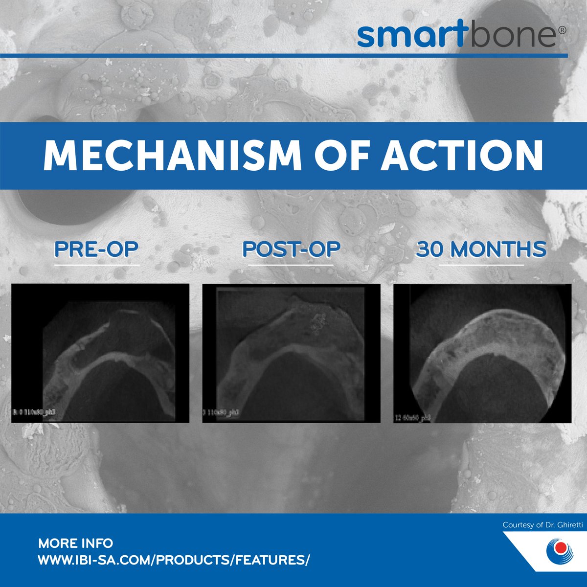 smartboneibi's tweet image. #SmartBone® is revolutionizing the world of #grafts with its #innovative #mechanism of action!

Its #integration with the natural bone and subsequent resorption is driven by its substitution with healthy living #bone from the host, thanks to its key feature of #remodeling.