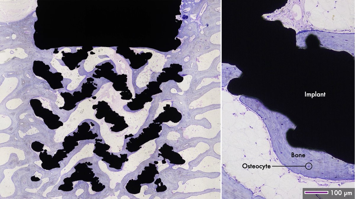 #Bone ingrowth into #porous #metal #implants manufactured by #3Dprinting. #Histology reveals bone and #adiposetissue inside large #titanium #alloy structures. On closer inspection, bone is closely adapted to the surface of the metal struts.
🧵1/5