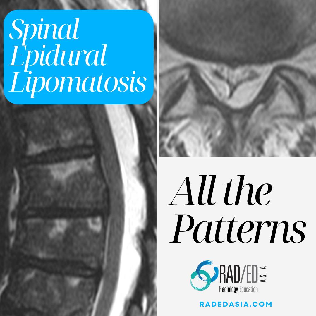 Spinal epidural lipomatosis in the lumbar or thoracic spine. All the patterns to look for on MRI.
More at this link: bit.ly/selpatterns

#radiology #radedasia #spinemri #radiologist #rheumatology #arthritis #radiologia #lipomatosos #lumbarspine

1/n