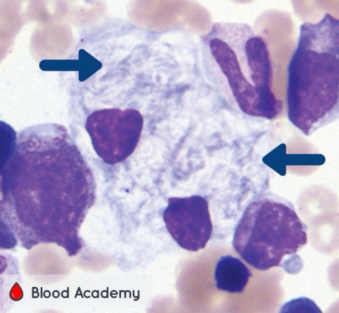 A young boy presented with chronic fatigue and hepatosplenomegaly. Bone marrow aspirate histology is shown below. What is the likely diagnosis? (Image: ASH) #MedTwitter