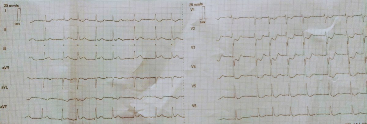 Labelled NSTEMI, surprisingly went into cardiac arrest during transportation between 2 hospitals...