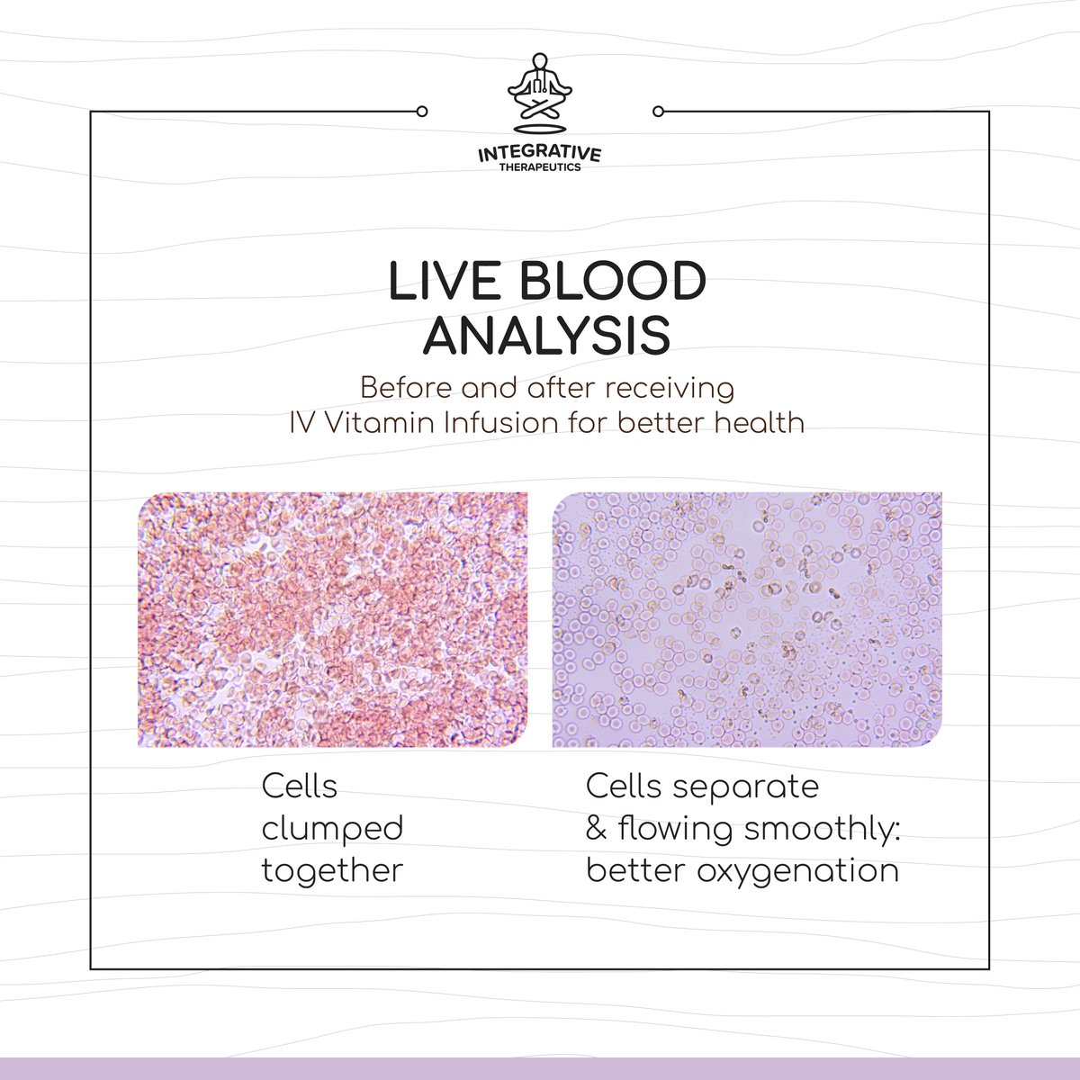 Graphic representation of Rouleaux formation and how IV therapy can help. Get your complimentary consultation with Dr. K and get the best possible solutions for your health and wellness. 

#holisticwellness #functionalmedicine #holistichealer #holisticnutrition #yogaexercise