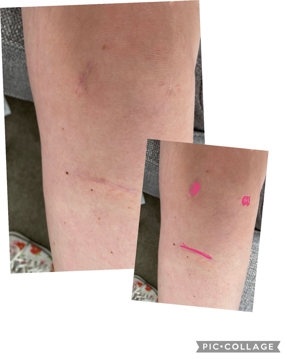 Anyone part of the meh face scar gang? 
#aclrecovery #aclreconstruction #meh #scars #kneesurgery