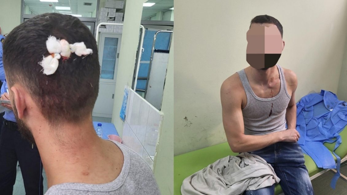 Two Albanian citizens were attacked today in the north of #Mitrovica. 

#KosovoPolice announced that they were attacked by a group of criminals who were masked and organized for the attack.

#StandWithKosovo