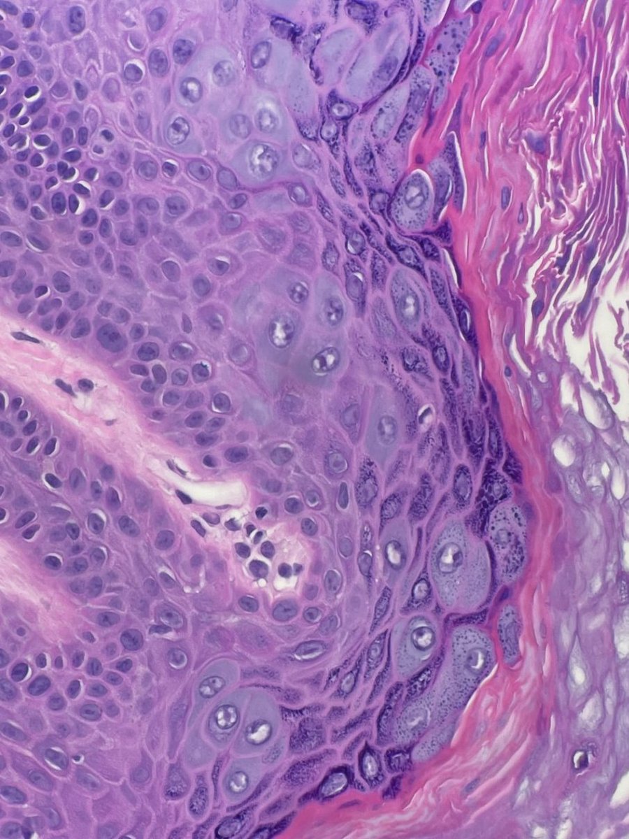 So cool when you read about something and then it pops up under your scope. This is a good example of the blue keratinocytes seen in epidermodysplasia verruciformis.

#dermpath #dermatology #Pathtwitter #medtwitter
