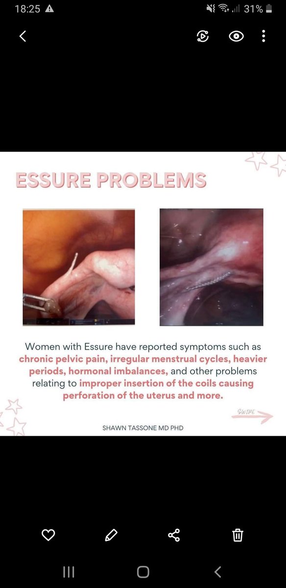 GemaPG3's tweet photo. PROBLEMAS DE A < ​​ESSURE Las mujeres con Essure han informado síntomas como dolor pélvico crónico, ciclos menstruales irregulares, períodos más abundantes, desequilibrios hormonales y otros problemas relacionados con la inserción incorrecta de las bobinas que causan la perfora. https://t.co/Q8pWFePXxj