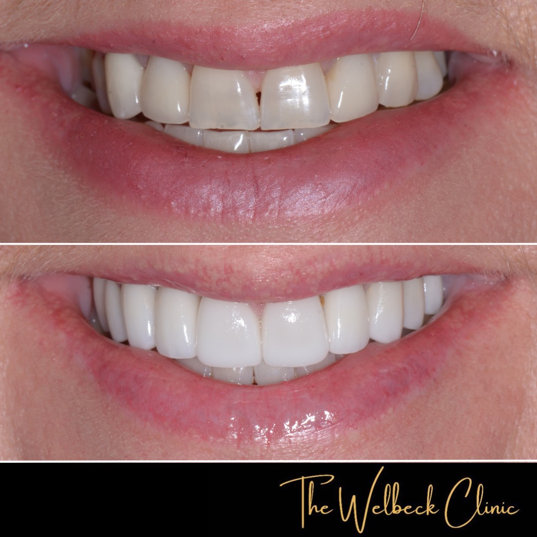 This patient attended after losing an existing veneer, she wanted to improve her overall smile. 
The patient had 10 upper veneers and whitening on the lower teeth with Dr ilaty to improve to smile. 
To book a consultation contact us on 0207 486 8100
#smilemakeover #veneers