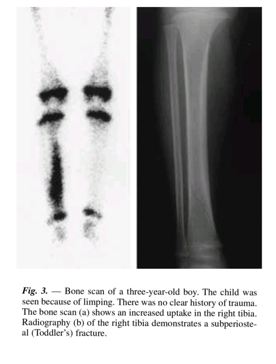 rabenlabga's tweet photo. #toddlersfracture
#bonescan https://t.co/7HojK4Bmpk