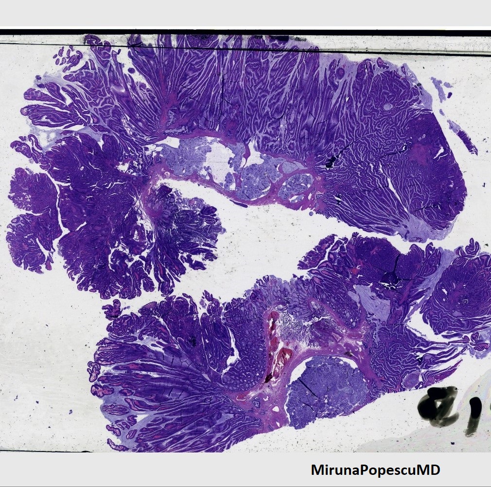 One very low-power #GIPath image.
1. What type of polyp is it? (colon)
2. What is happening in the submucosa?
3. Benign or malignant?
4. What would suggest one and not the other?

Higher-power images will be posted in the comments.

#PathTwitter #pathresidents #pathfellows