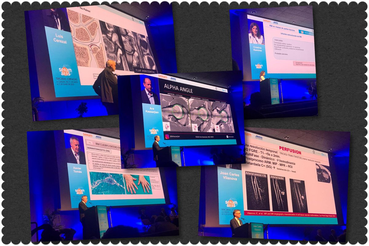 SERME (@mskserme) on Twitter photo La #SERME genialmente representada en #SERAM2023ARRS
👏🏻👏🏻👏🏻
<a href="/akassarjian/">Ara Kassarjian, MD, FRCPC</a> Ara Kassarjian
<a href="/DmcRadiologia/">Luis Cerezal</a> Luis Cerezal
<a href="/gadolinio61/">Gadolinio61 Dr. Xavier TOMAS BATLLE</a> Xavier Tomas
<a href="/KaiVilanova/">Kai Vilanova</a> Kai Villanova
Cristina Ramírez
<a href="/SERAM_RX/">SERAM - Sociedad Española de Radiología Médica</a>
#mskrad #mri 🦴🧲 La #SERME genialmente representada en #SERAM2023ARRS
👏🏻👏🏻👏🏻
<a href="/akassarjian/">Ara Kassarjian, MD, FRCPC</a> Ara Kassarjian
<a href="/DmcRadiologia/">Luis Cerezal</a> Luis Cerezal
<a href="/gadolinio61/">Gadolinio61 Dr. Xavier TOMAS BATLLE</a> Xavier Tomas
<a href="/KaiVilanova/">Kai Vilanova</a> Kai Villanova
Cristina Ramírez
<a href="/SERAM_RX/">SERAM - Sociedad Española de Radiología Médica</a>
#mskrad #mri 🦴🧲