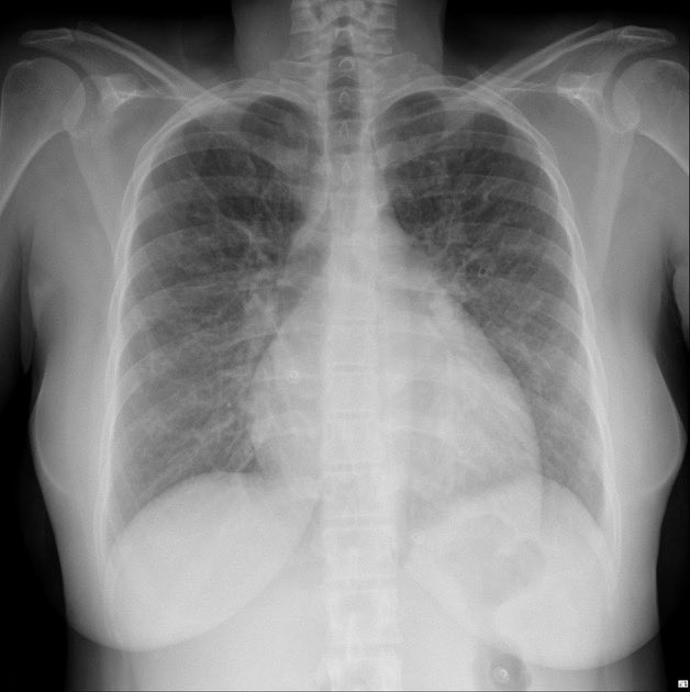 mir_munazzah's tweet photo. 35 year old female, delivered a week ago, no known medical history. What is the likely diagnosis?
( Image @Radiopedia, case by Henry Knipe)
A #Tweetorial , #MedTwitter #obgyntwitter https://t.co/OWY7BF78mU