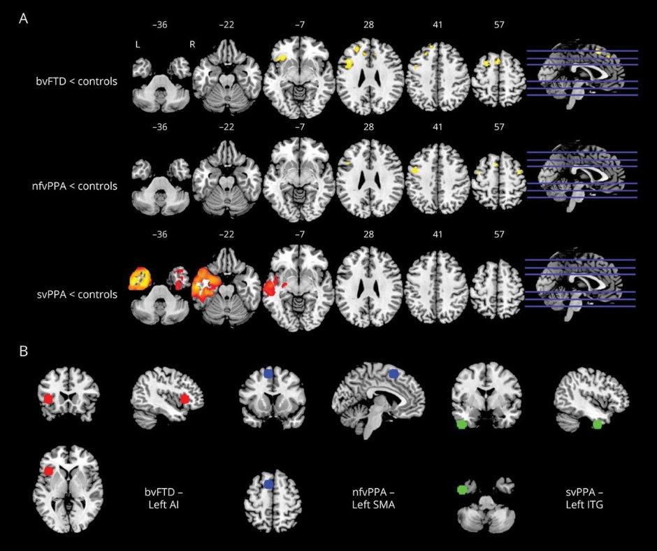 Functional Connectivity From Disease Epicenters in Frontotemporal Dementia: bit.ly/3qbWXKN

#NeuroTwitter