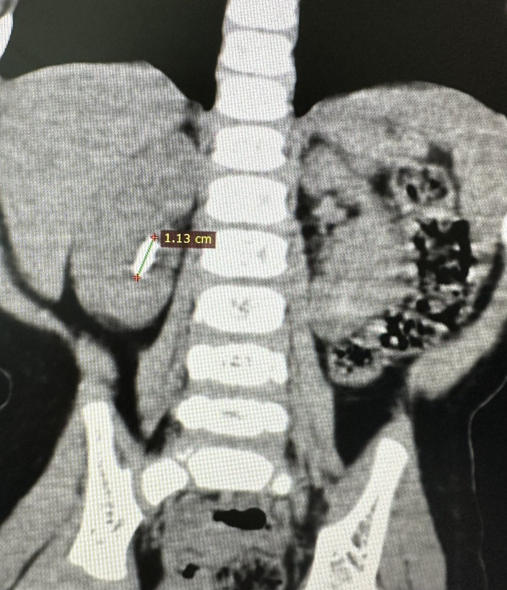 Girl 18 months old and with this kind of diseases!!! Stones are increasing in chilhood!!! @siupurol @Residentes_SMU @ResidentesCAU