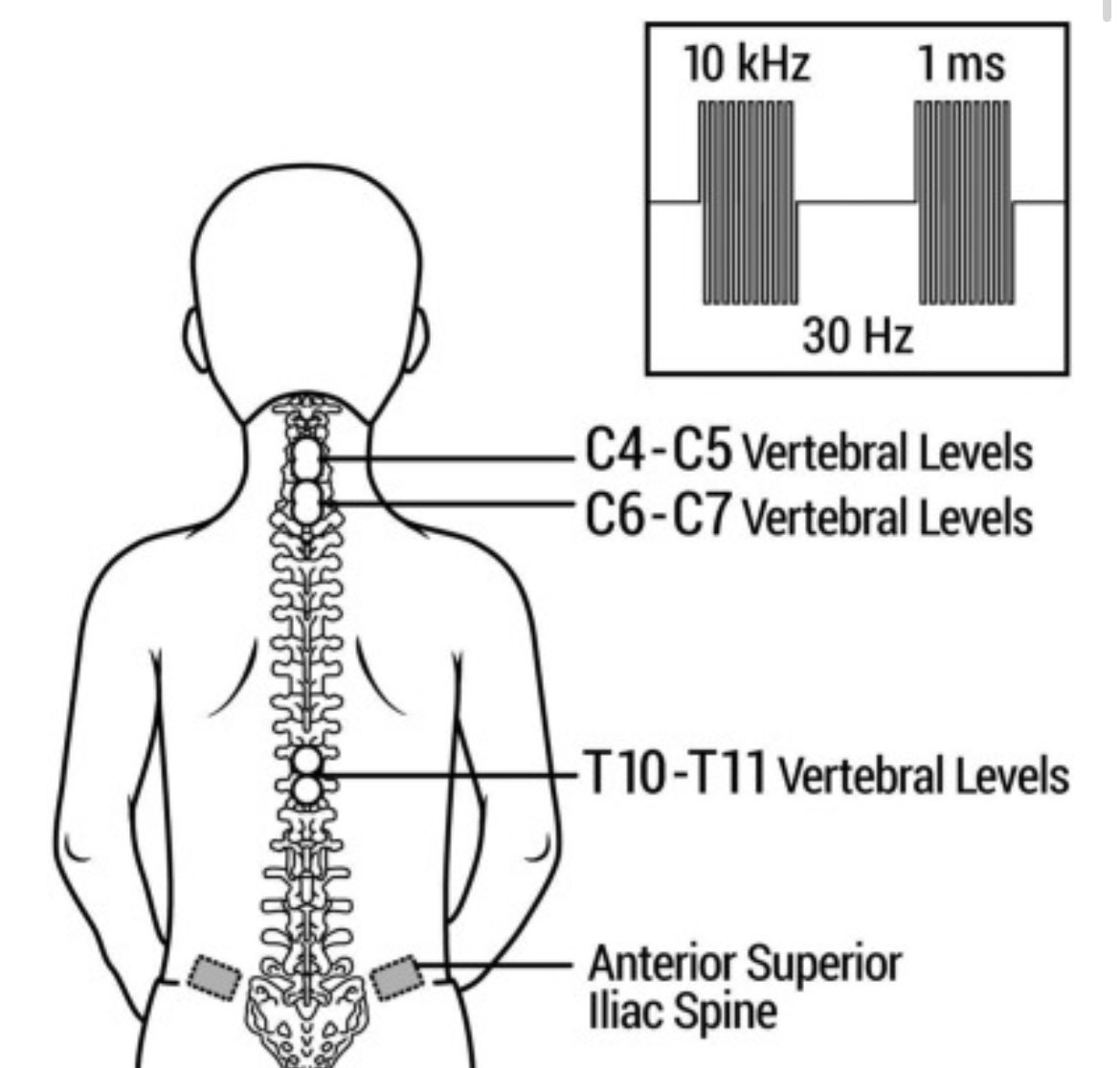 Our new article reporting safety and feasibility of noninvasive multi-site spinal cord stimulation to improve hand function in #pediatric #SCI is out now 🙌🏻, check it out here sciencedirect.com/science/articl…