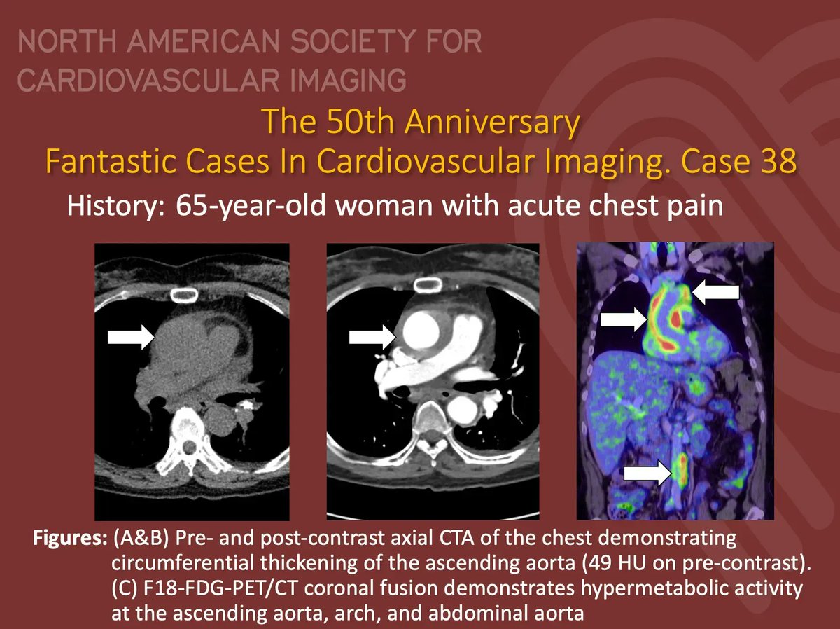 #NASCI 50th Anniversary weekly cases are back!!!

Case 38

Courtesy of @JRevRad1 and S Elman at University of New Mexico

What is the right answer?

#whyCMR #YesCCT

@GregKicska @JRevRad1 @dianalitmano @DanielVargasMD @kirschj @prachipagarwal  @AwsHamid5 @DeCeccoCN @CarlottaOnnis