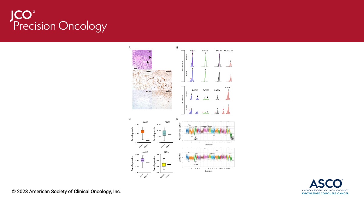 JCO Precision Oncology (@jcopo_asco) on Twitter photo .<a href="/LotanLab/">Tamara Lotan, MD</a> et al. highlight challenges associated with commercial molecular assays in evaluating MLH1-deficient prostate tumors ➡️ fal.cn/3yKbl #pcsm .<a href="/LotanLab/">Tamara Lotan, MD</a> et al. highlight challenges associated with commercial molecular assays in evaluating MLH1-deficient prostate tumors ➡️ fal.cn/3yKbl #pcsm